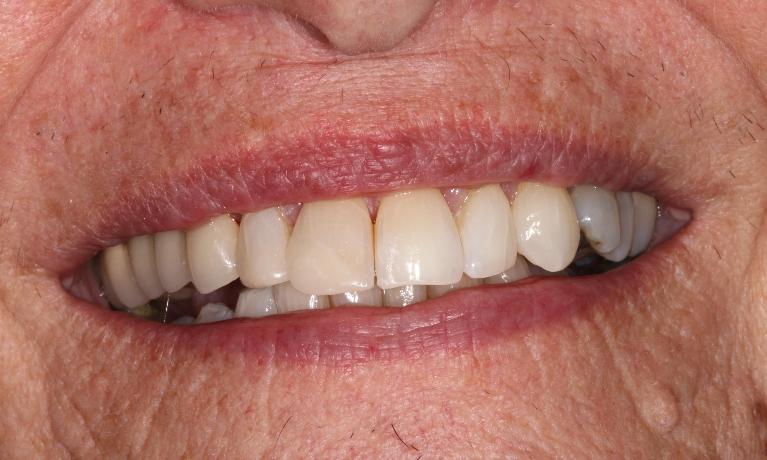 Bleaching-and-Composite-Buildups-After-Image