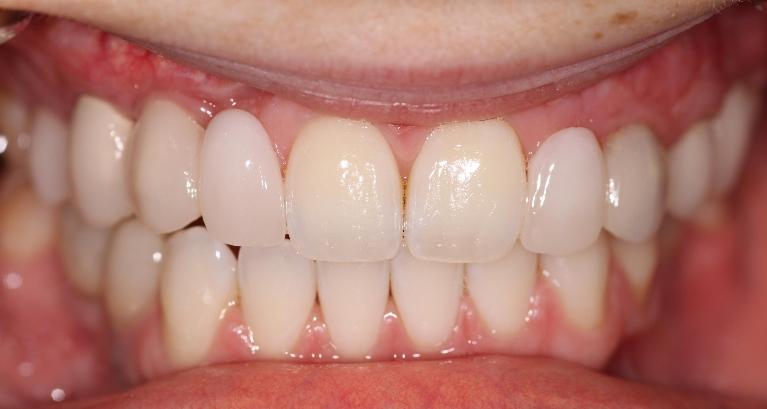 Smile-Makeover-After-Image