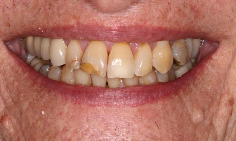 Bleaching-and-Composite-Buildups-Before-Image