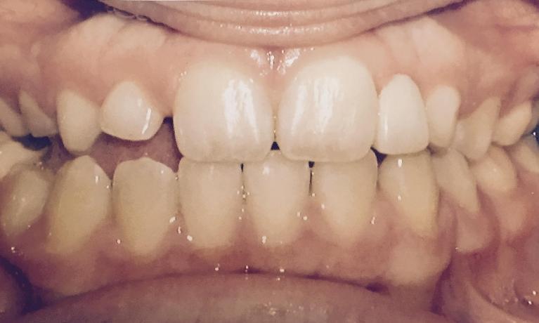 Smile-Makeover-Before-Image
